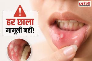 हर मुंह का छाला मामूली नहीं होता! 2-3 हफ्ते तक न भरे तो हो सकता है गंभीर बीमारी का संकेत